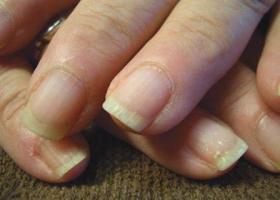 Расслоение и ломкость ногтей: причины, лечение и профилактика