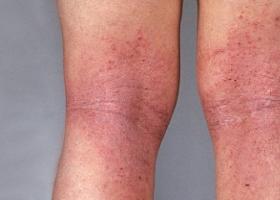 Красные пятна на ногах — виды, симптомы, причины, лечение