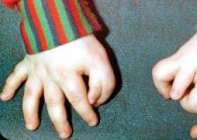 Аномалия развития конечностей: что делать, если у ребенка шесть пальцев на руках или ногах